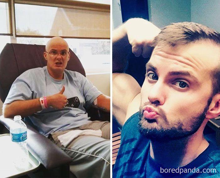 People Who Beat Cancer In Powerful Before & After Pictures