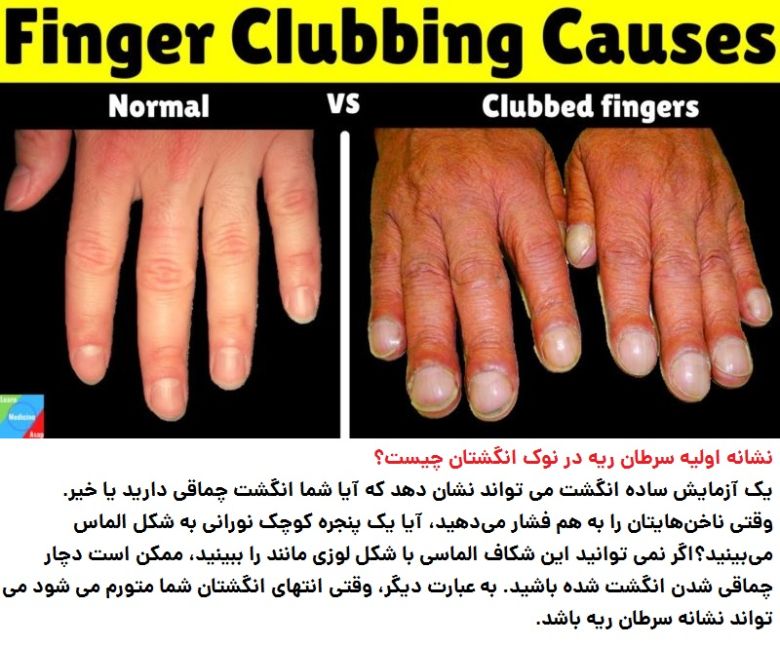 finger-test-may-reveal-early-sign-of-lung-cancer