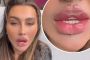 Expert warns against 'butterfly lips' filler trend