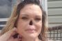 After losing her nose, the woman chose to discard her prosthesis