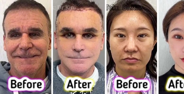 Social media reacts to TikTok doctor's before-and-after transformations of facelifts