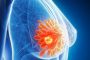 New Frontiers in Cancer Treatment: Mounjaro's Potential Beyond Weight Loss