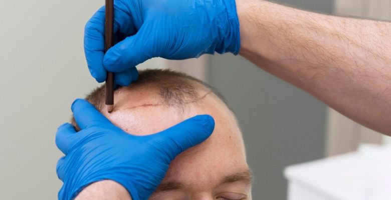 Beyond the Grafts: The Complete Guide to Hair Transplant Complications