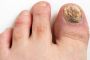 Your Toenails Know More Than You Do: The Hidden Health Clues Below the Surface