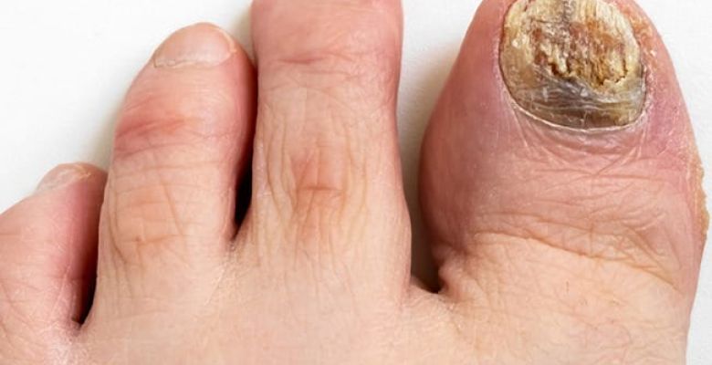 Your Toenails Know More Than You Do: The Hidden Health Clues Below the Surface
