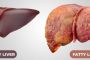 10 Warning Signs Your Liver is Crying Out for Help: Identifying Fatty Liver Disease