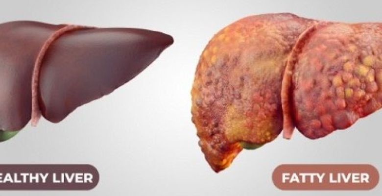 10 Warning Signs Your Liver is Crying Out for Help: Identifying Fatty Liver Disease